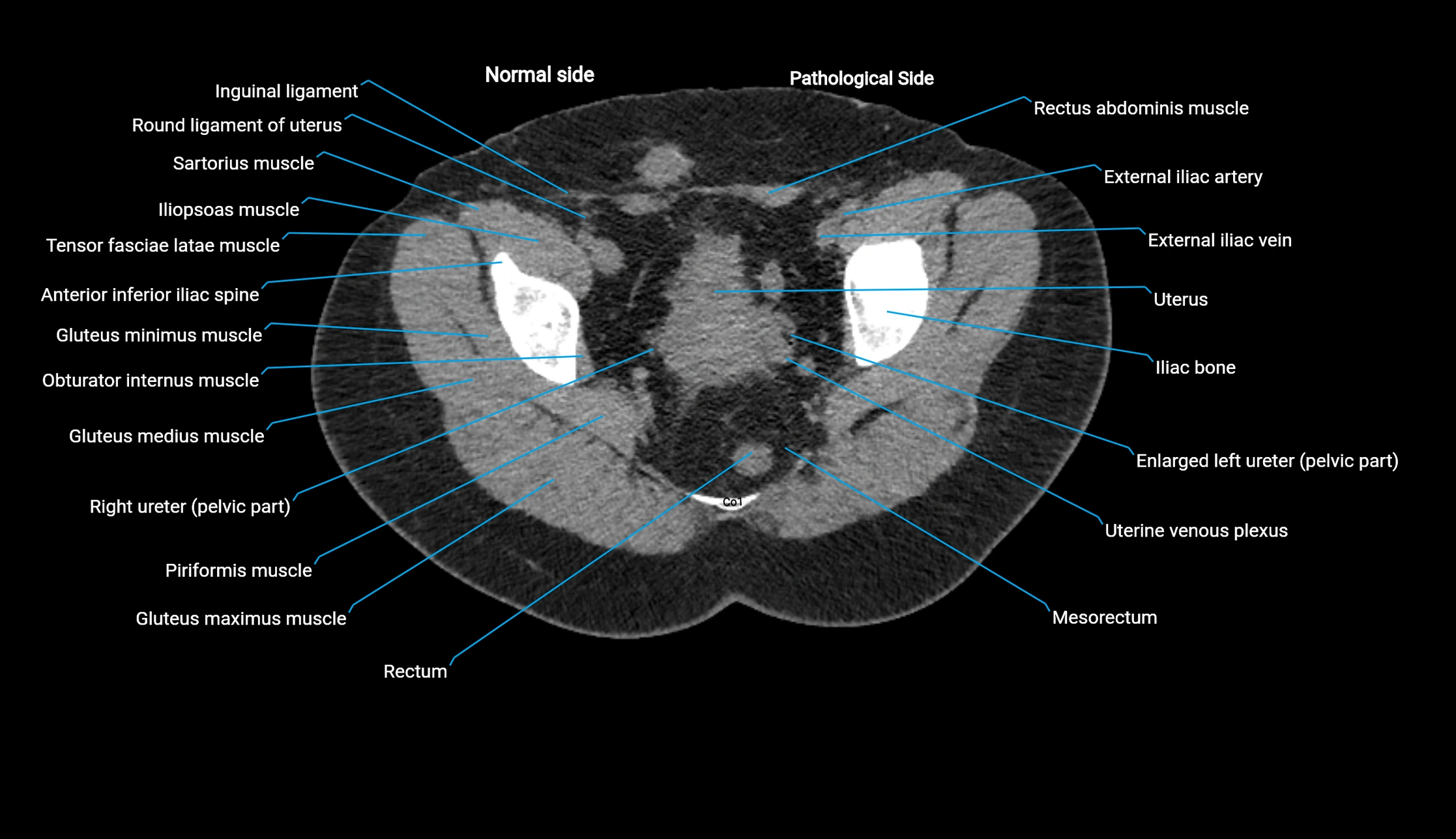 CT KUB axial cross sectional anatomy  radiology image -img-00201-00148.webp